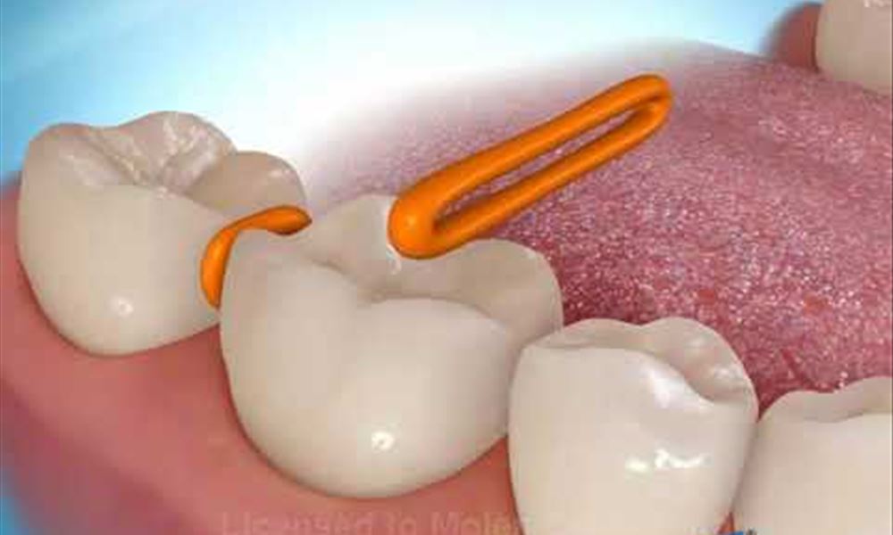 Tooth Separators